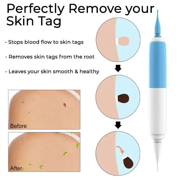 Remove your skin tags painlessly at home 